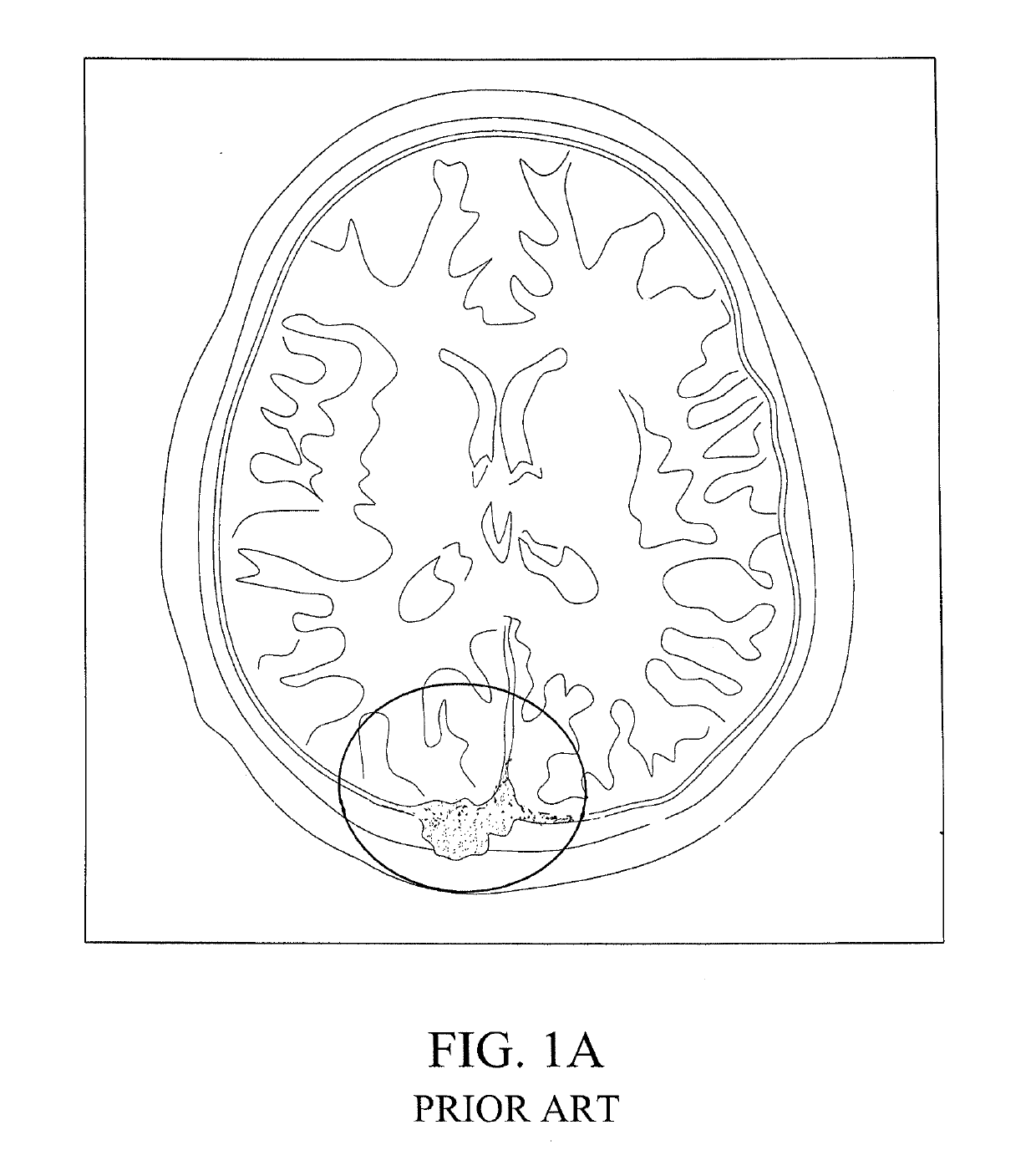 Method for performing single-stage cranioplasty reconstruction with a clear custom craniofacial implant