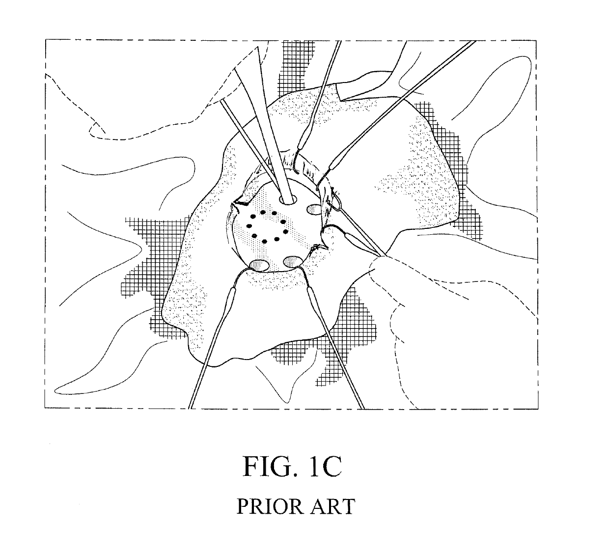 Method for performing single-stage cranioplasty reconstruction with a clear custom craniofacial implant