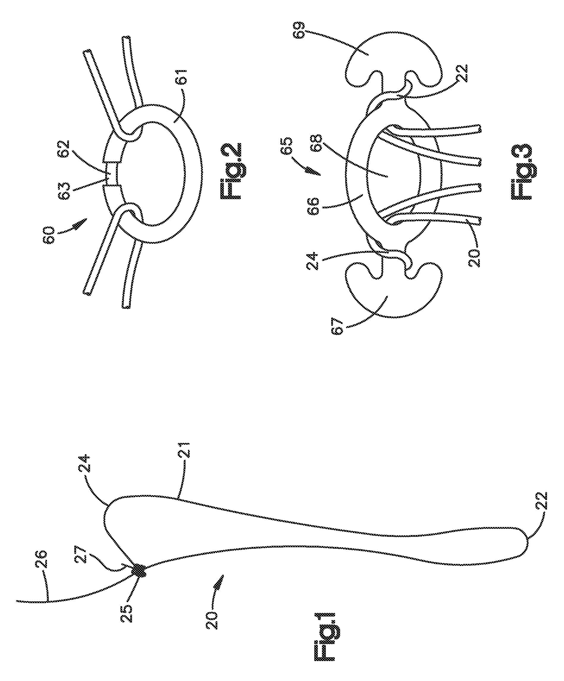 Suture based tissue repair