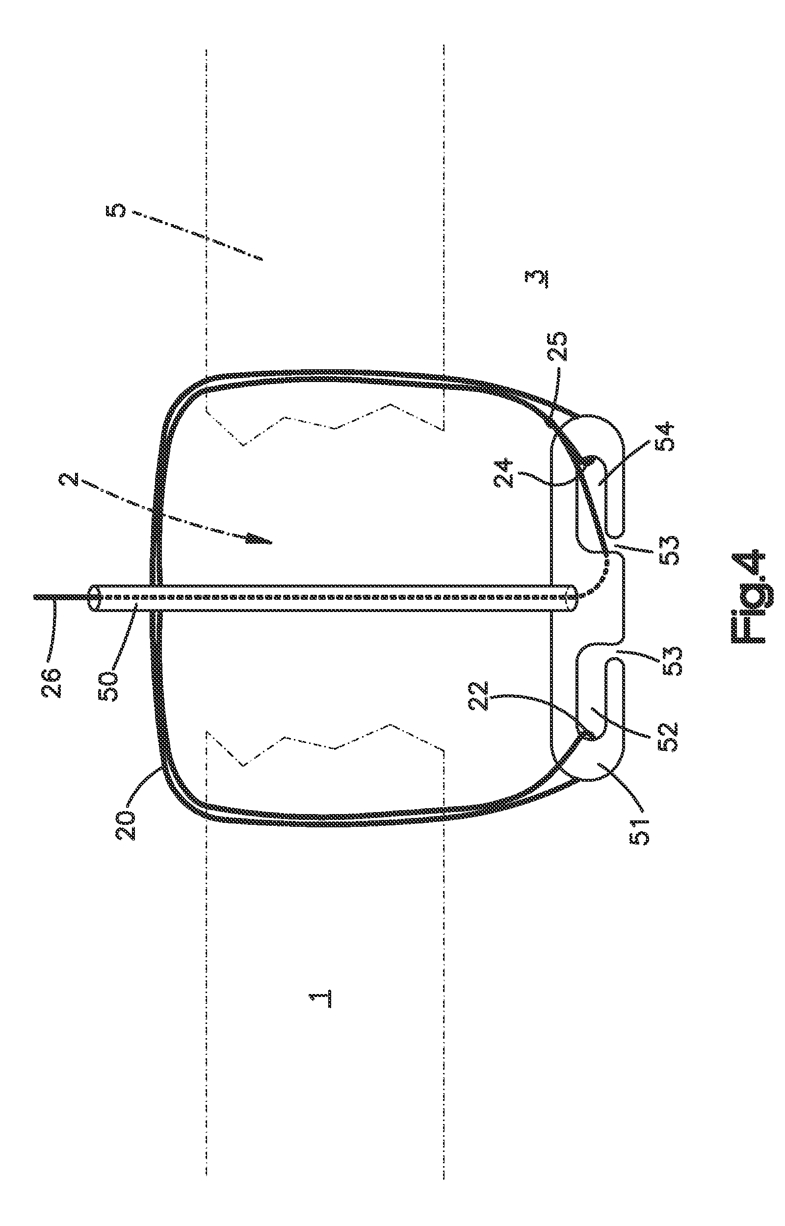 Suture based tissue repair