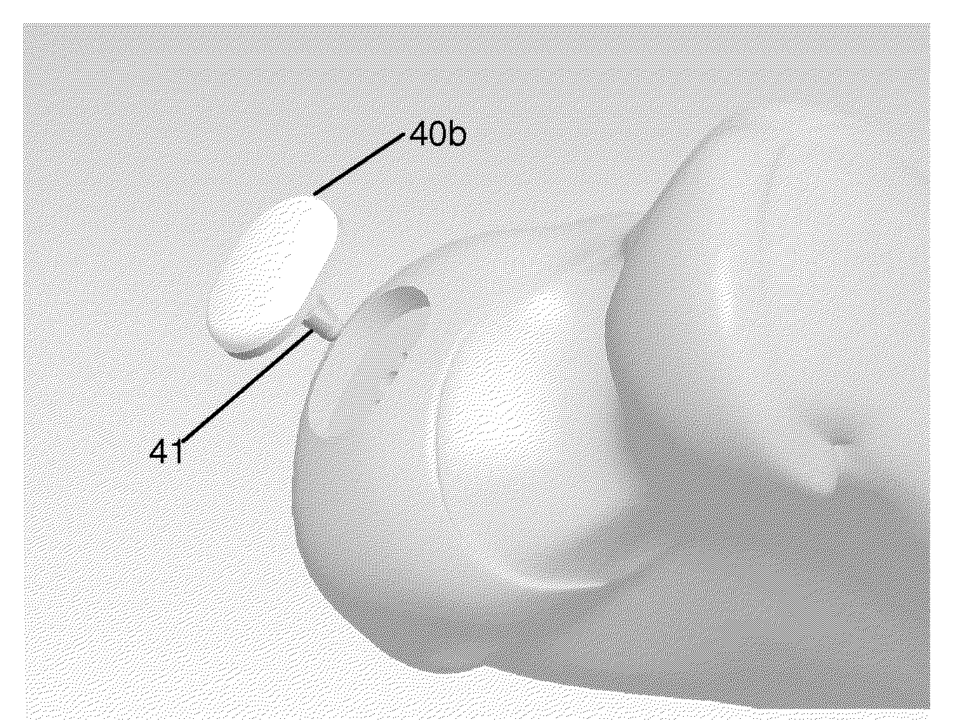 Partial joint resurfacing implant, instrumentation and method