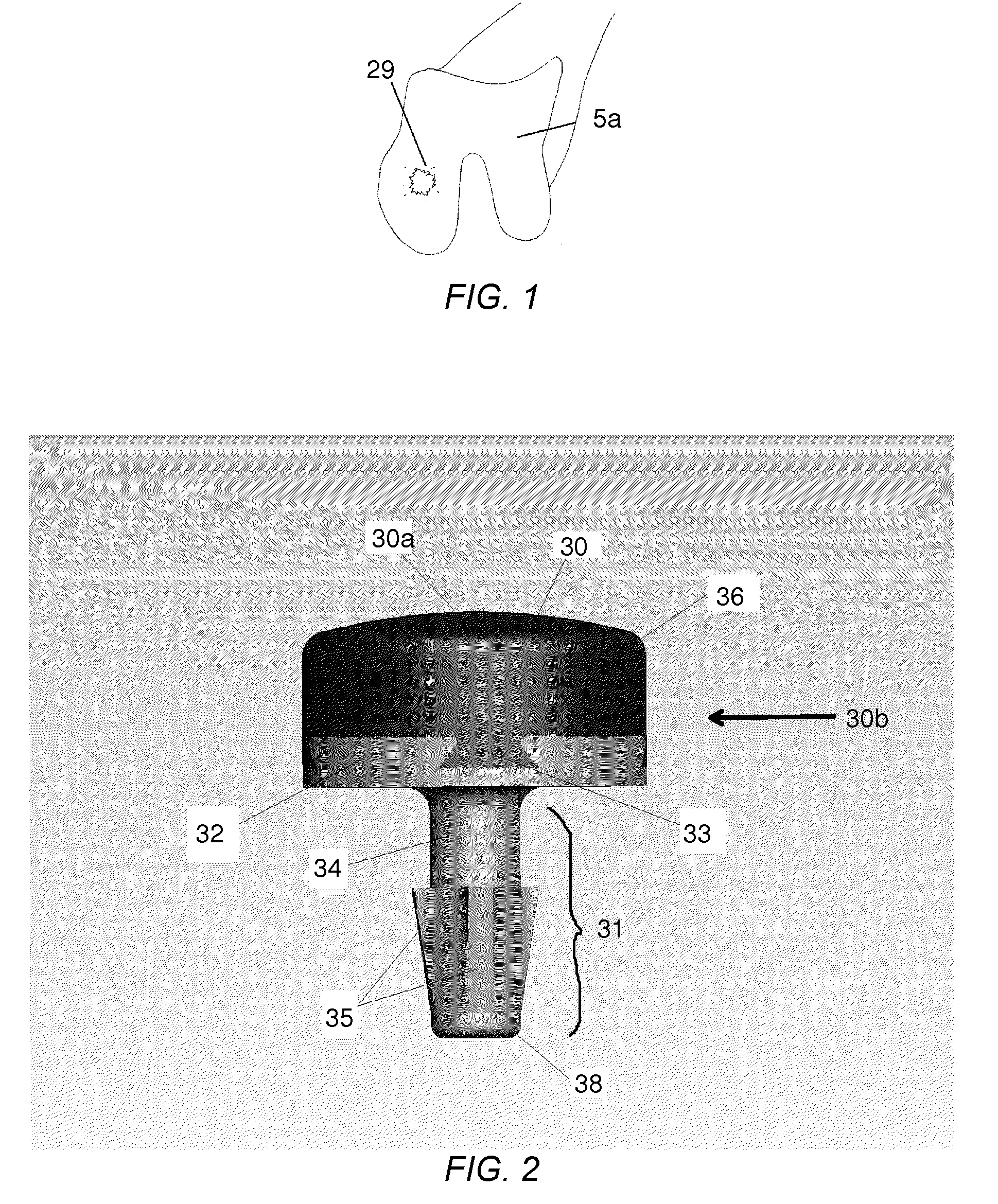 Partial joint resurfacing implant, instrumentation and method