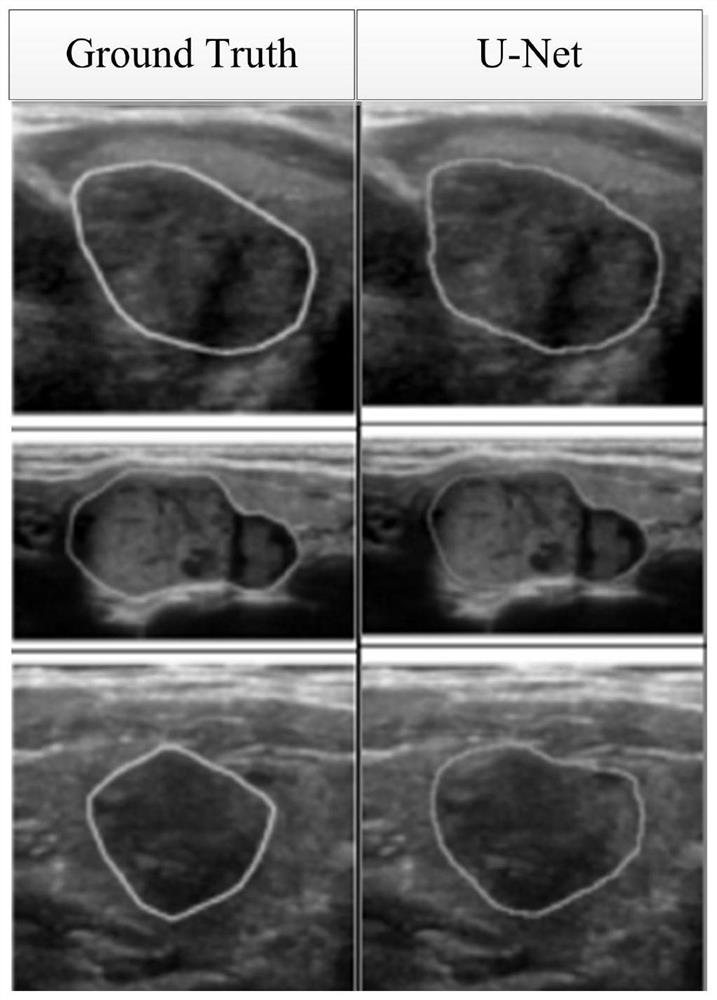 Ultrasonic thyroid nodule benign and malignant prediction method based on deep learning