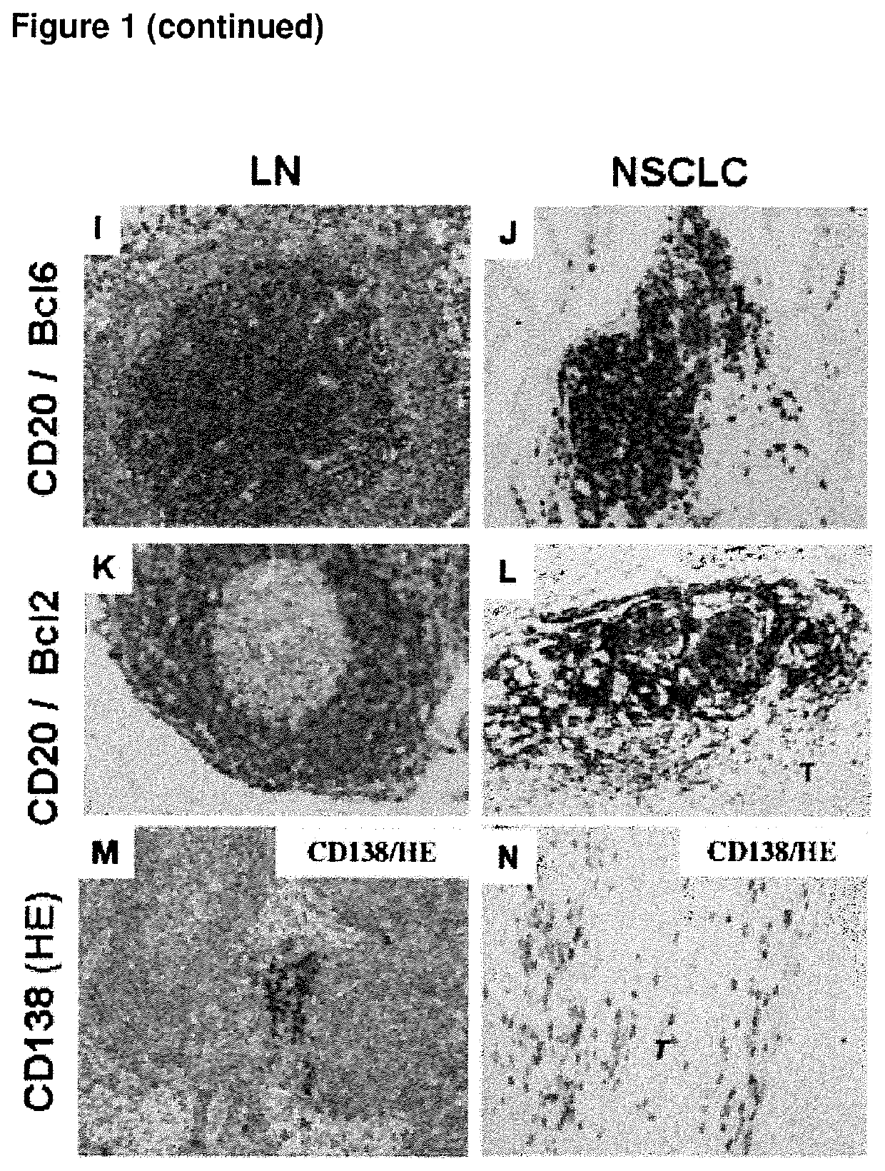 Method for the prognosis of survival time of a patient suffering from a solid cancer