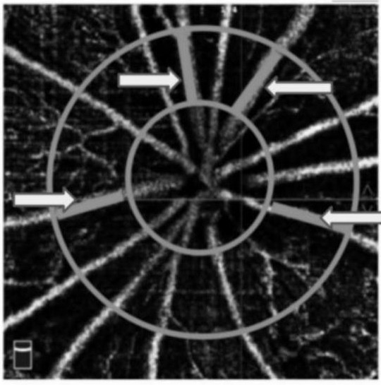 A method for establishing an animal model of retinal edema