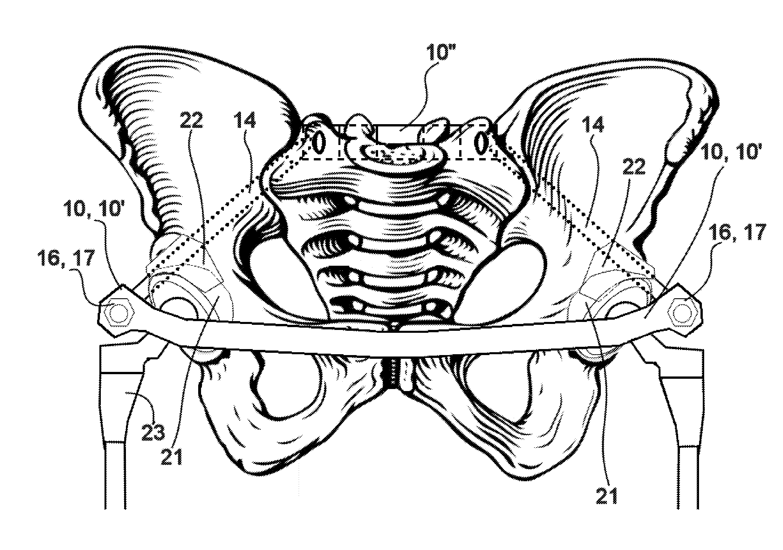 Method and Apparatus for Minimally Invasive Treatment of Unstable Pelvic Ring Injuries Combined with Hip Arthroplasty