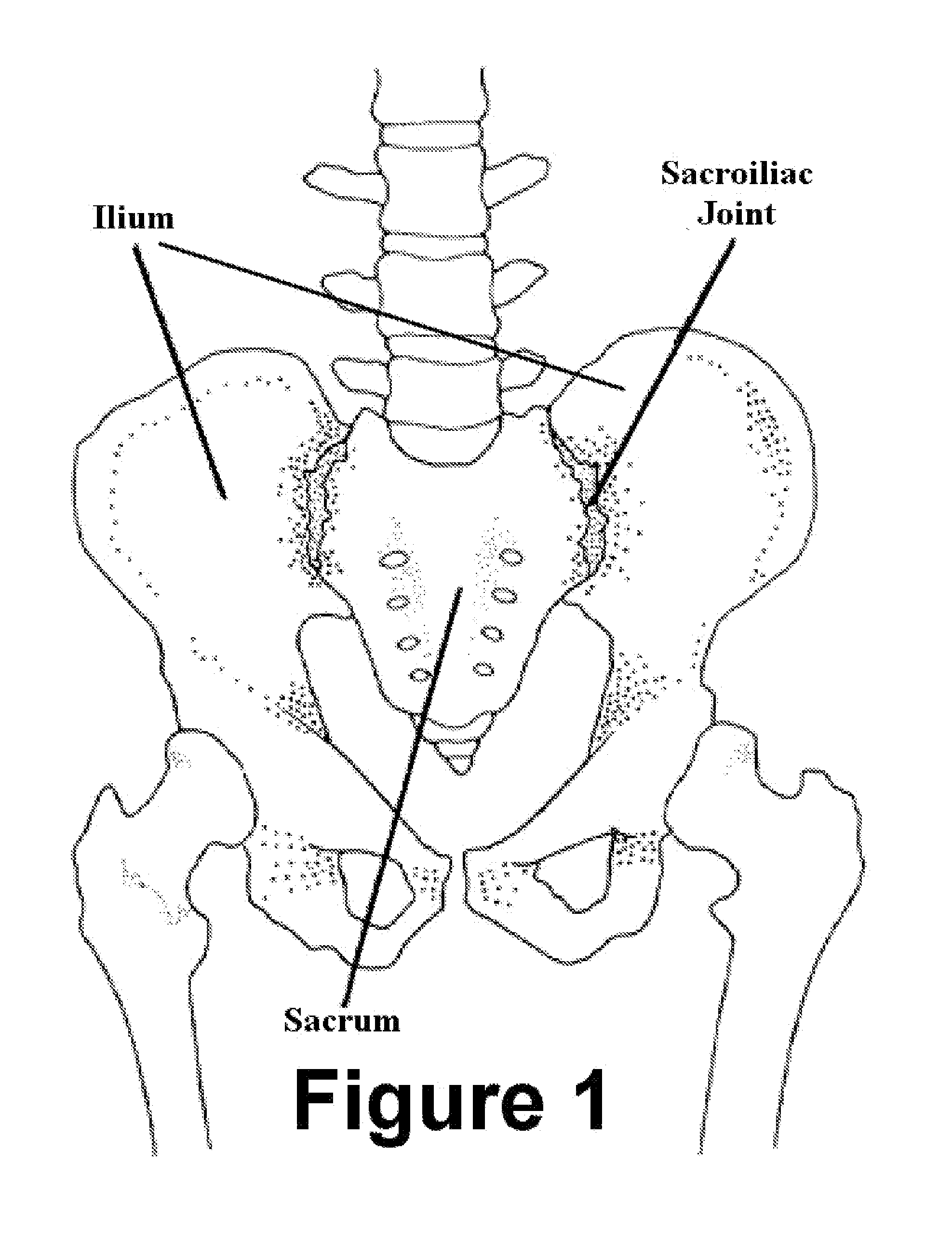 Method and Apparatus for Minimally Invasive Treatment of Unstable Pelvic Ring Injuries Combined with Hip Arthroplasty