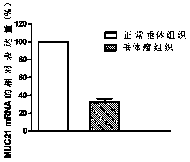 Application of muc21 gene and its expression product in diagnosis and treatment of pituitary tumor