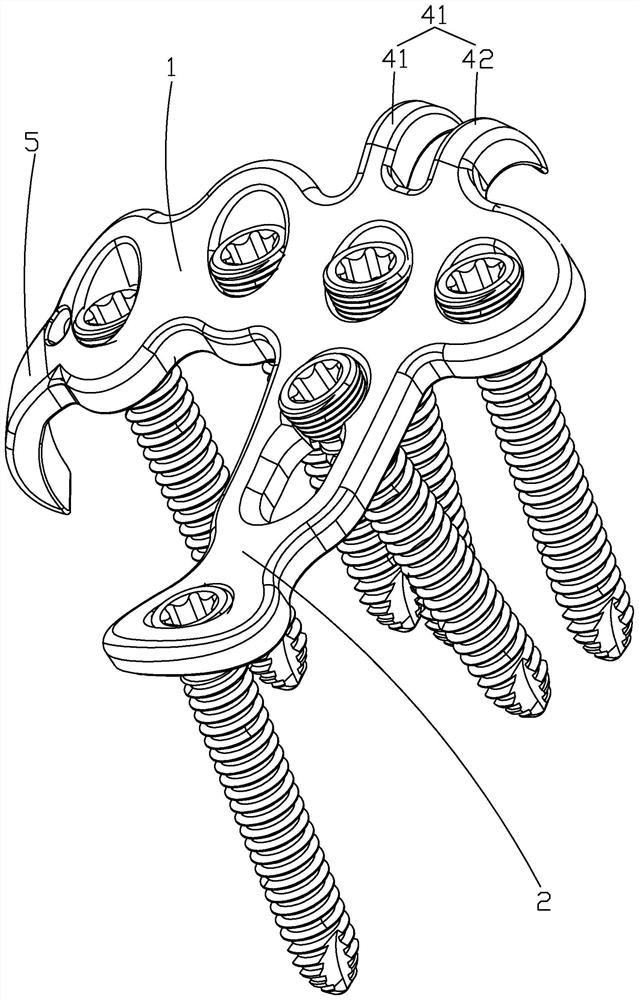 Ulna coracoid process locking plate