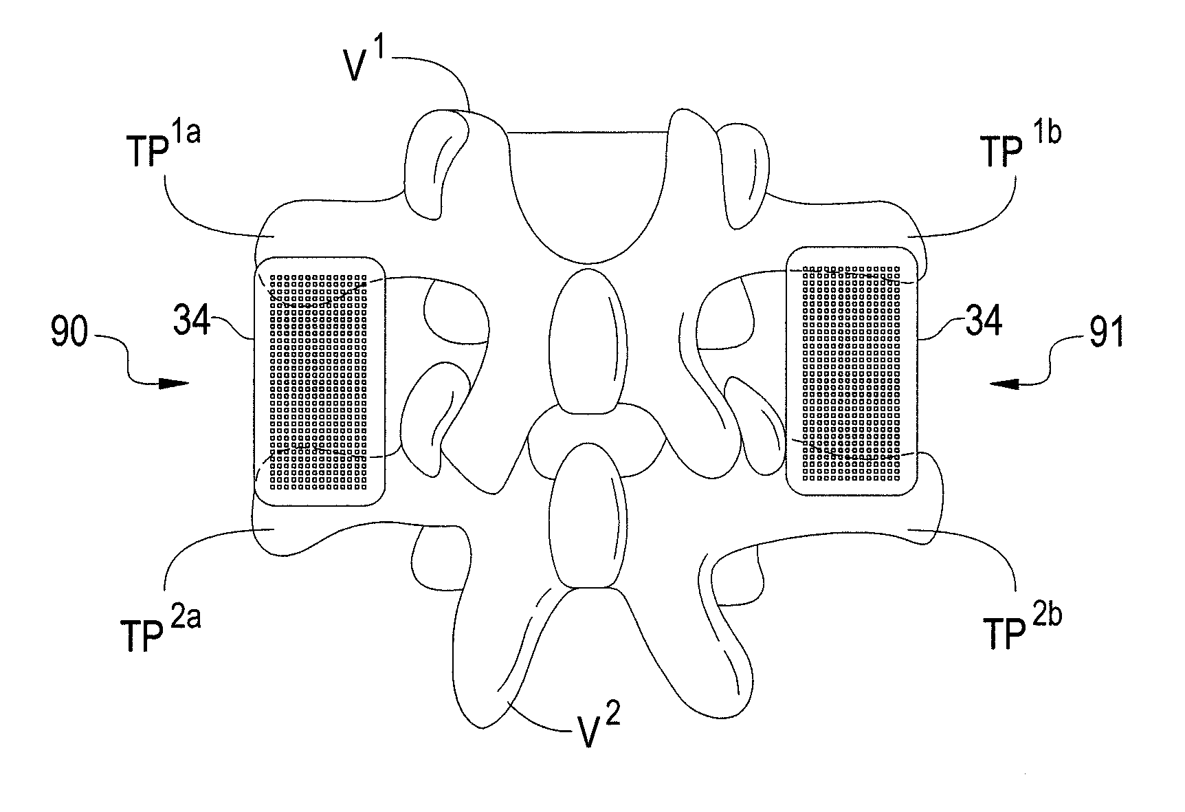 Osteoconductive Implants and Methods of Using Same