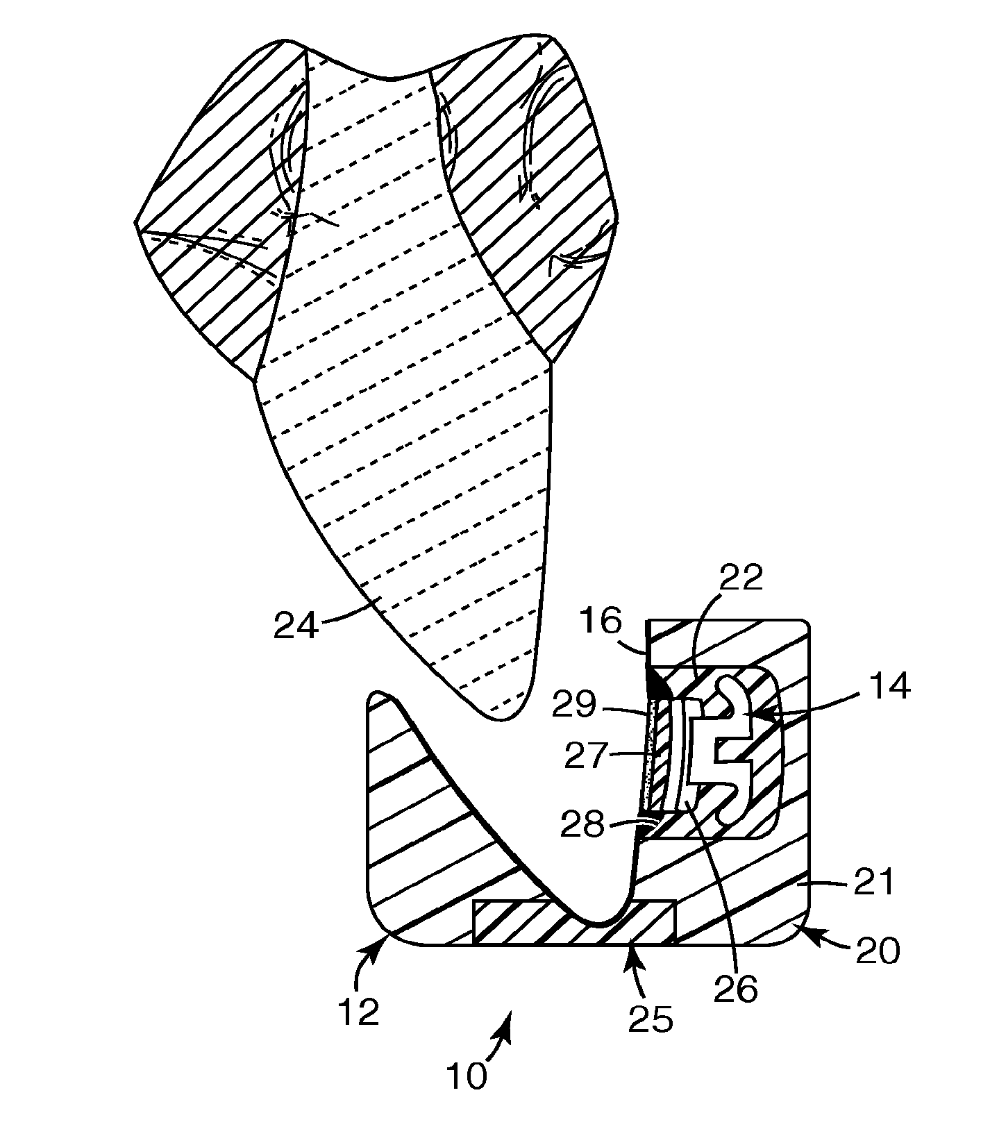 Methods and apparatus for applying dental sealant to an orthodontic patient's teeth