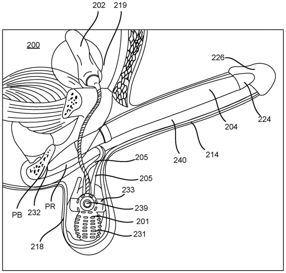 Inflatable penile prosthesis with a structured cylinder