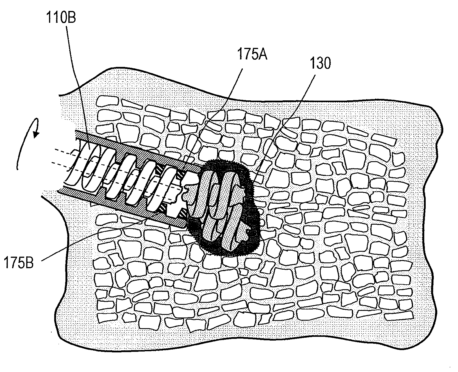 Methods for treating bone