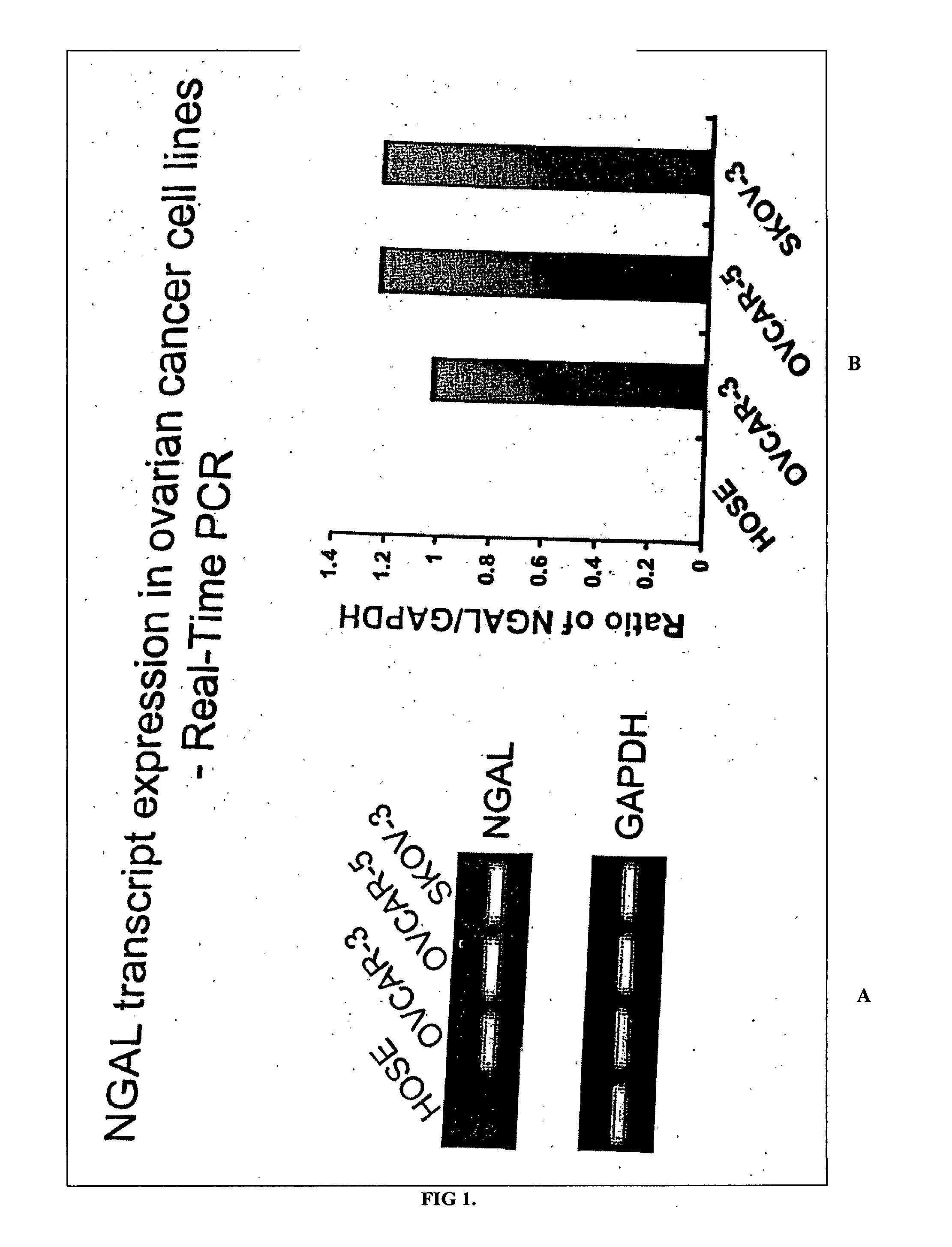 Free NGAL as a biomarker for cancer