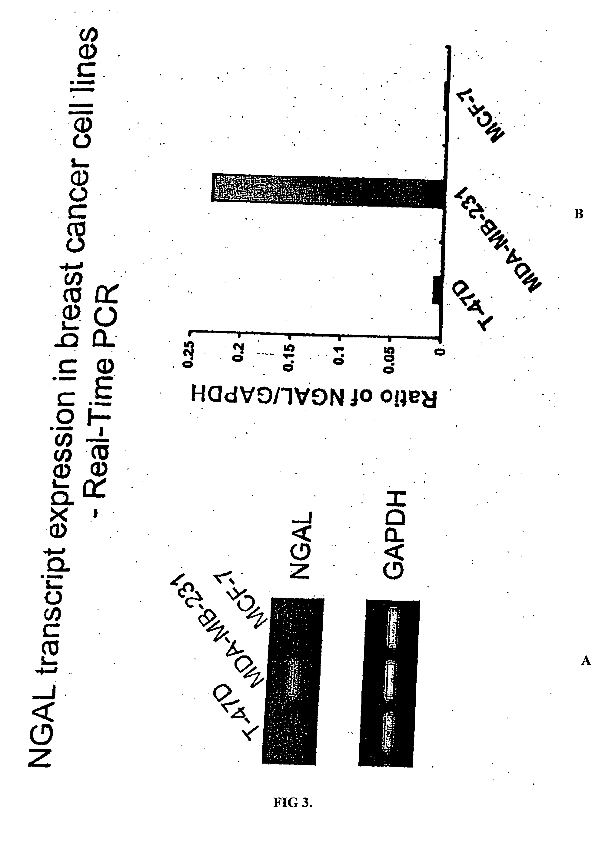 Free NGAL as a biomarker for cancer