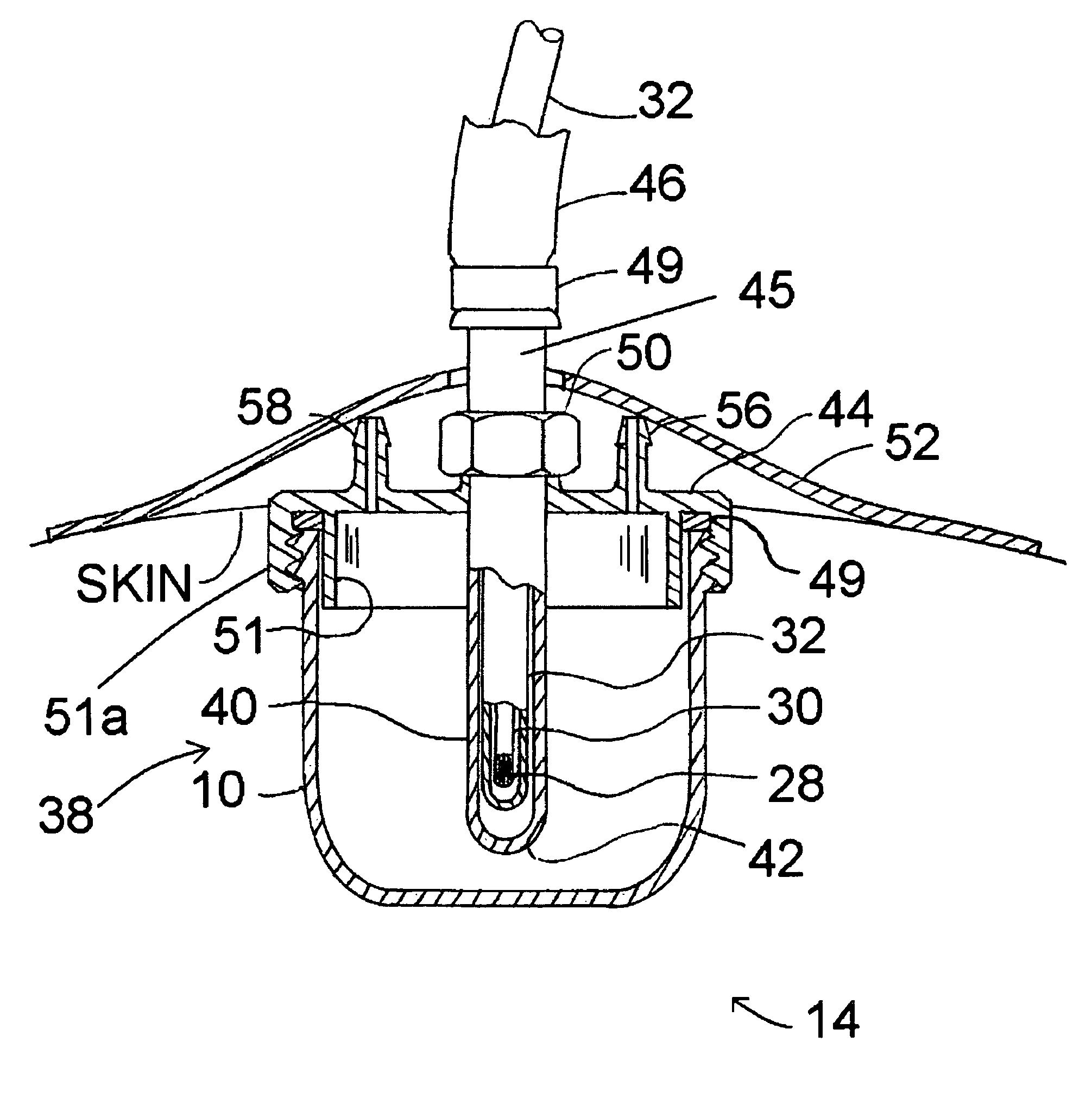 Applicators and methods for intraoperative treatment of proliferative diseases of the breast