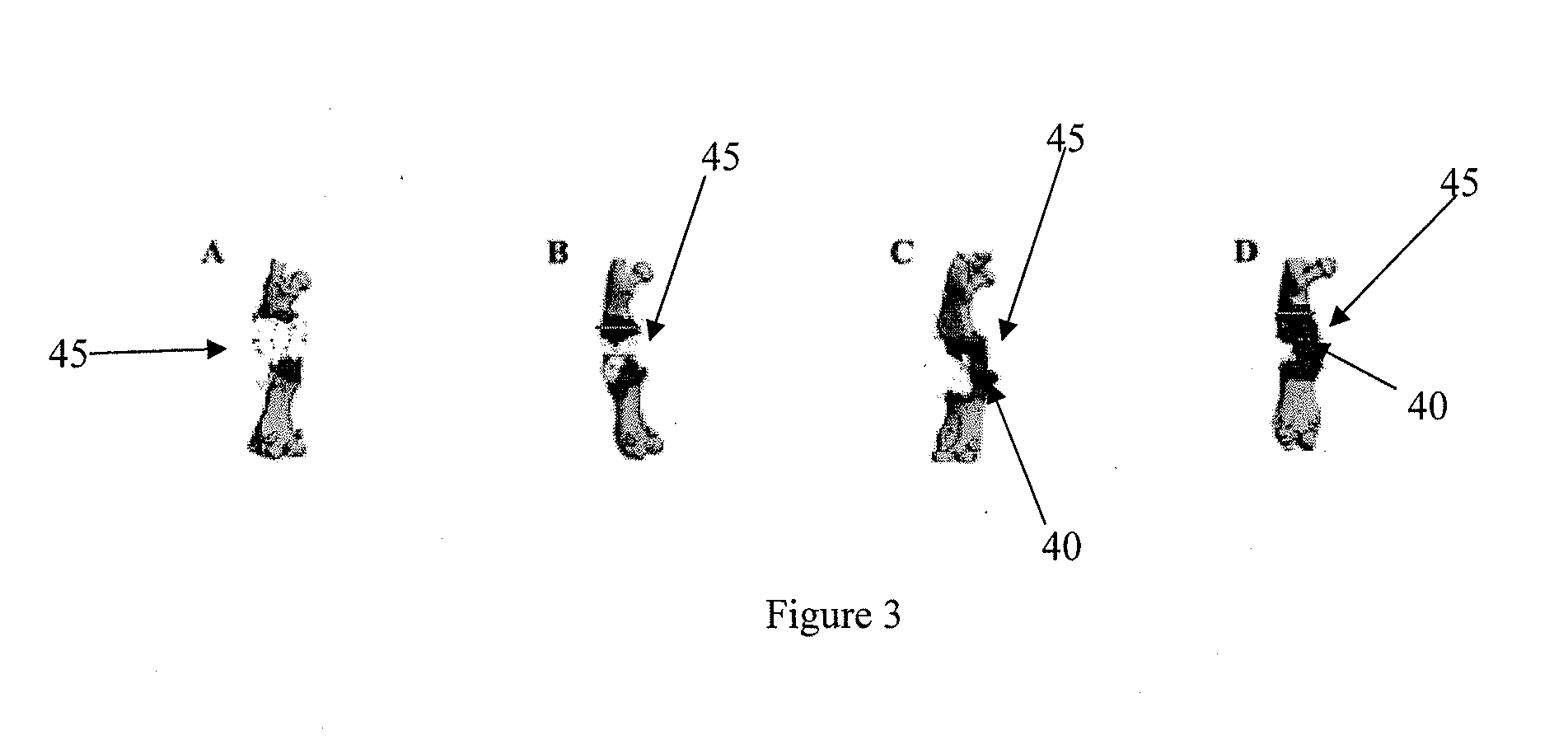 Parathyroid hormone treatment for enhanced allograft and tissue-engineered reconstruction of bone defects