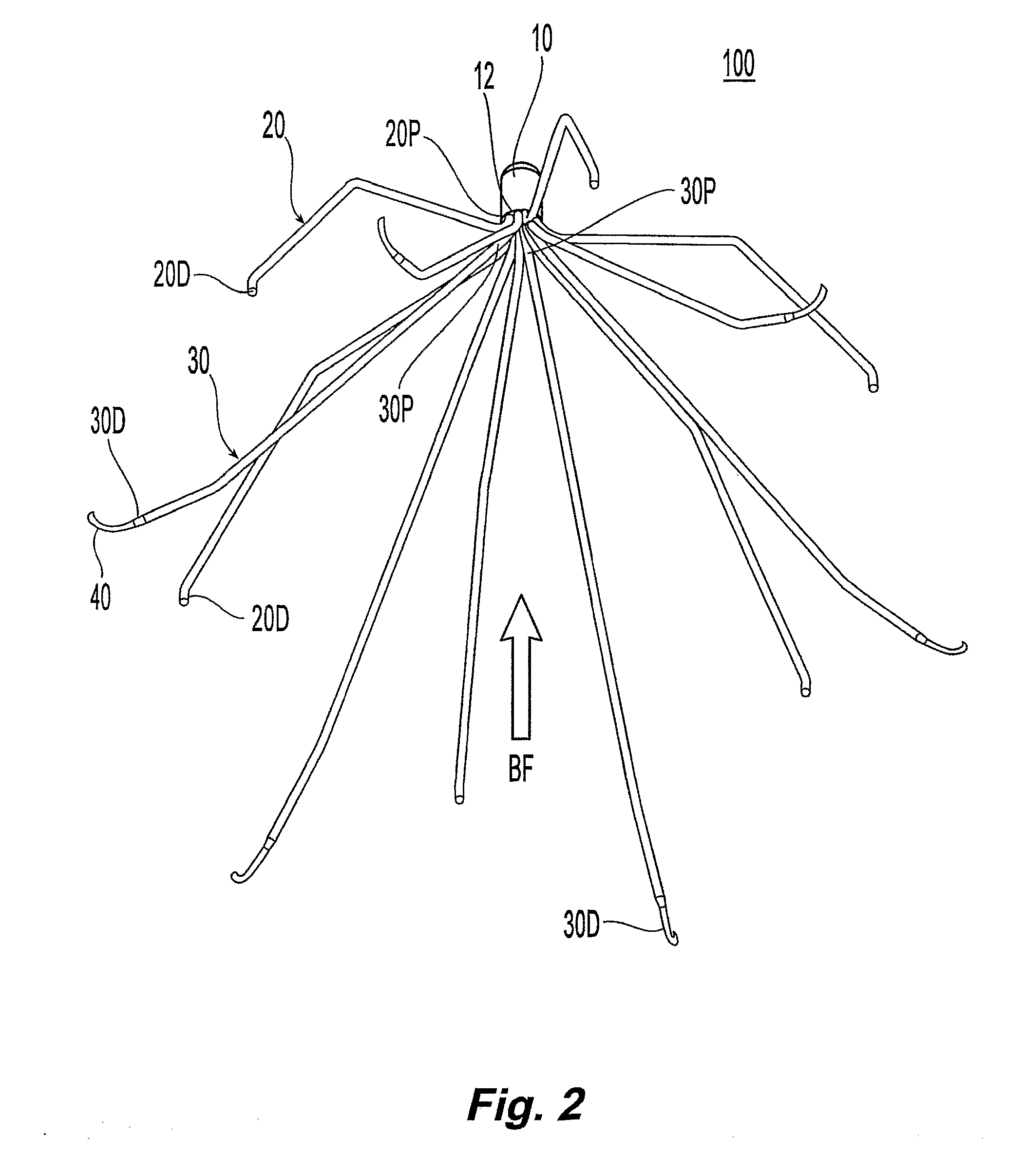 Removable blood clot filter with edge for cutting through the endothelium