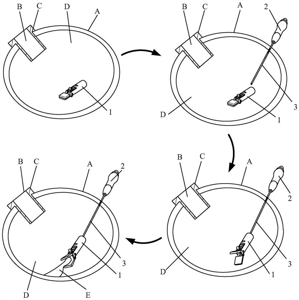 Endovascular Surgical Instruments