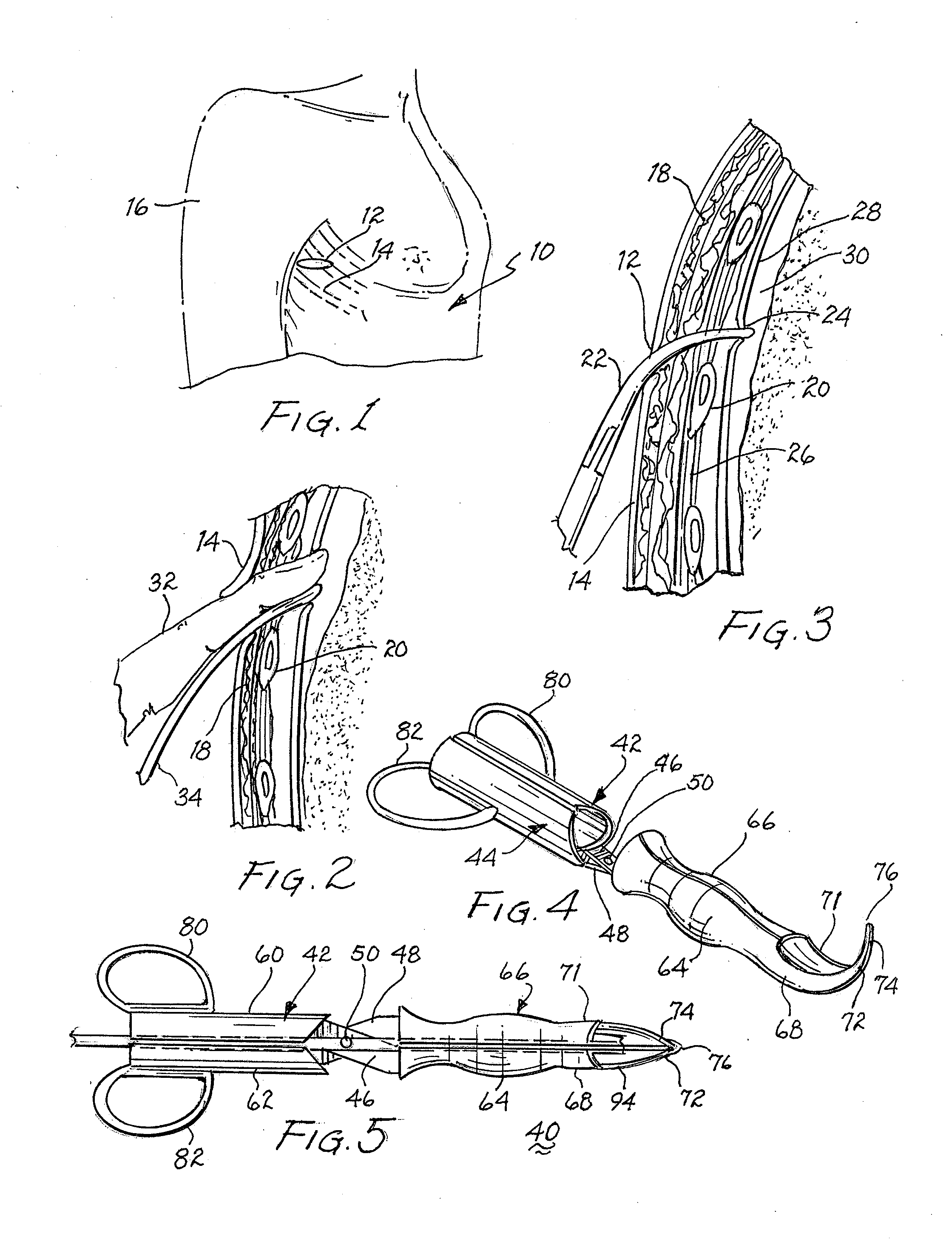 Medical instrument for inserting a chest drainage tube