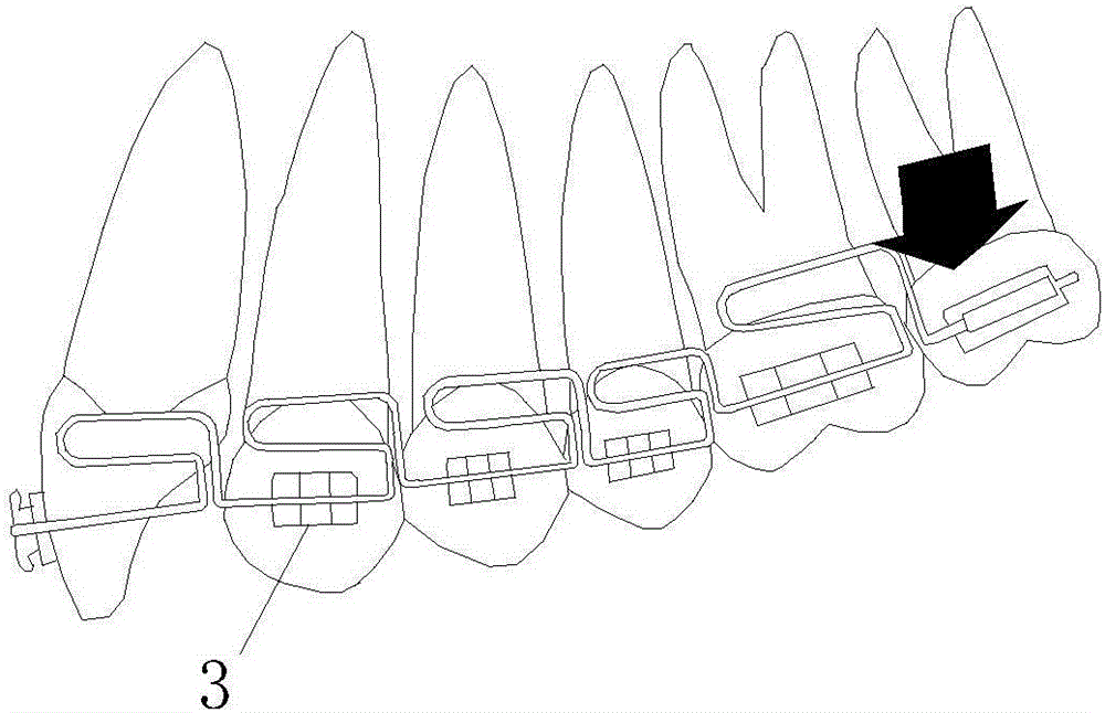 Multiloop edgewise arch wire for jaw malformation correction and jaw malformation correction method