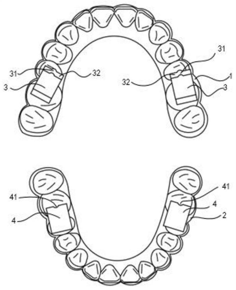 Shell-shaped dental instrument, tooth correction system and design method and preparation method of shell-shaped dental instrument