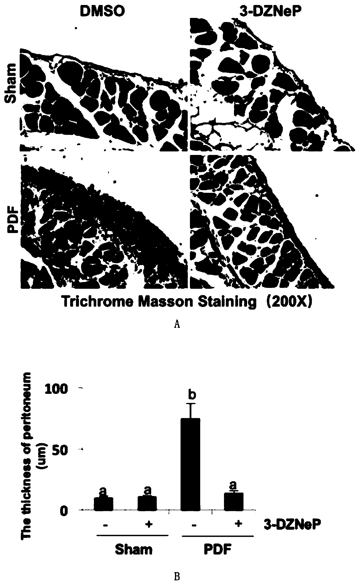 Application of inhibitor of histone methyltransferase EZH2 to preparing medicine for controlling peritoneum fibrosis after peritoneal dialysis