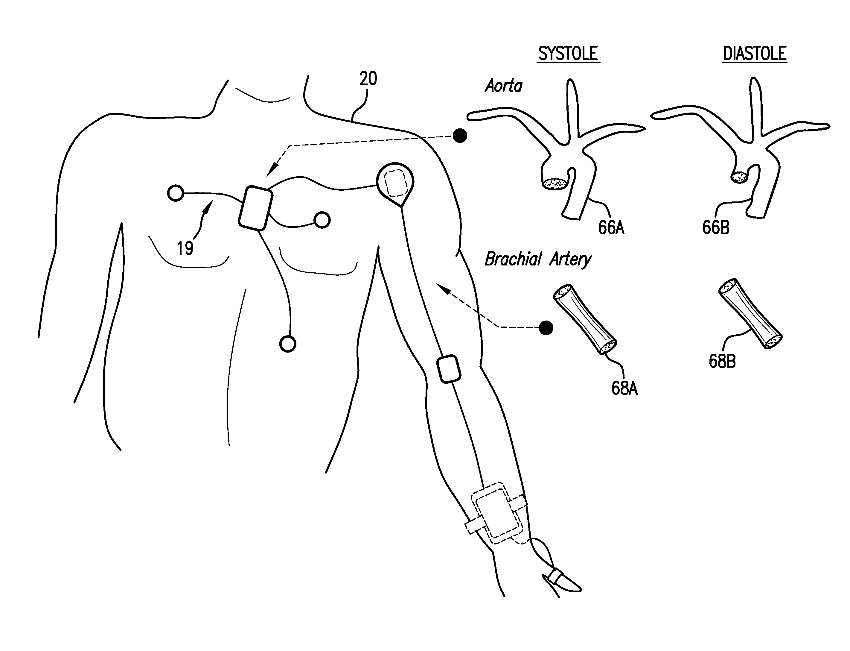 Body-worn system for continuous, noninvasive measurement of cardiac output, stroke volume, cardiac power, and blood pressure