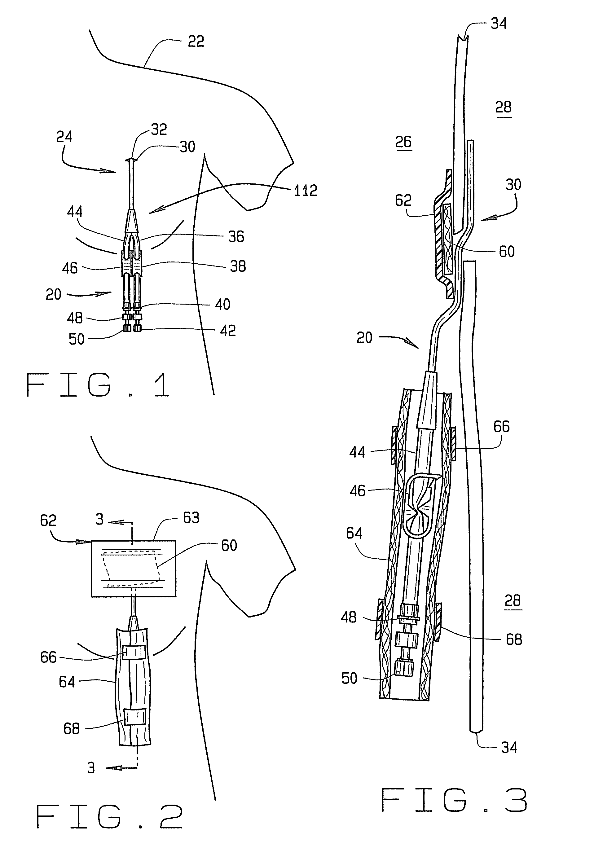 Disposable shower guard for renal access catheter