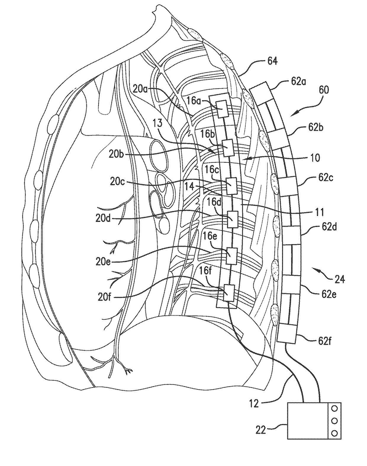 Implantable temporary nerve conduction blocking method and system