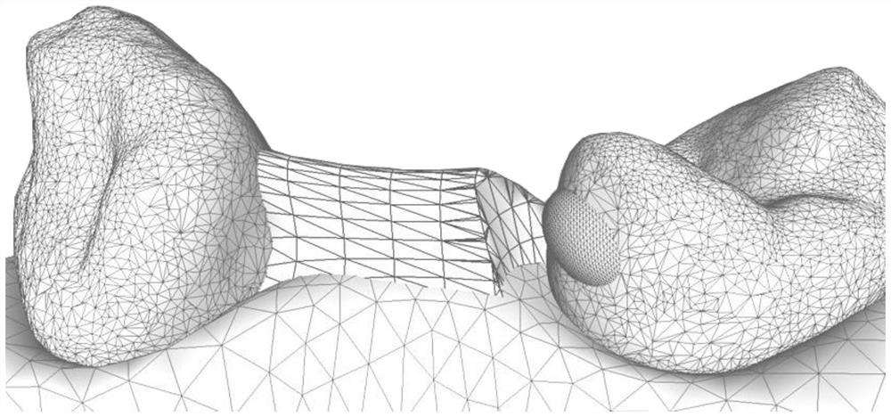 Accessory avoiding method and device for filling undercut of tooth digital model, medium and equipment