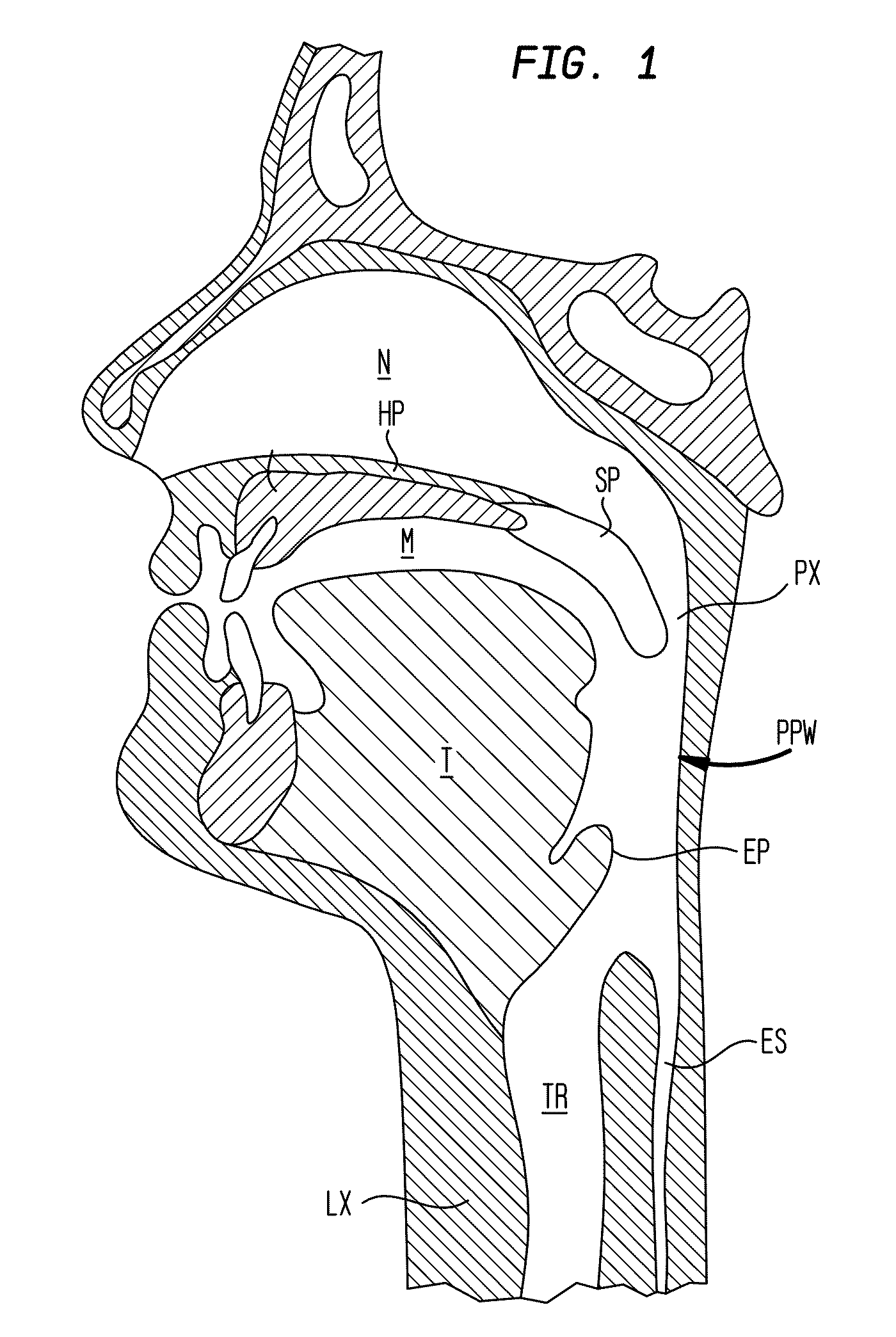 Tongue suspension system with hyoid-extender for treating obstructive sleep apnea