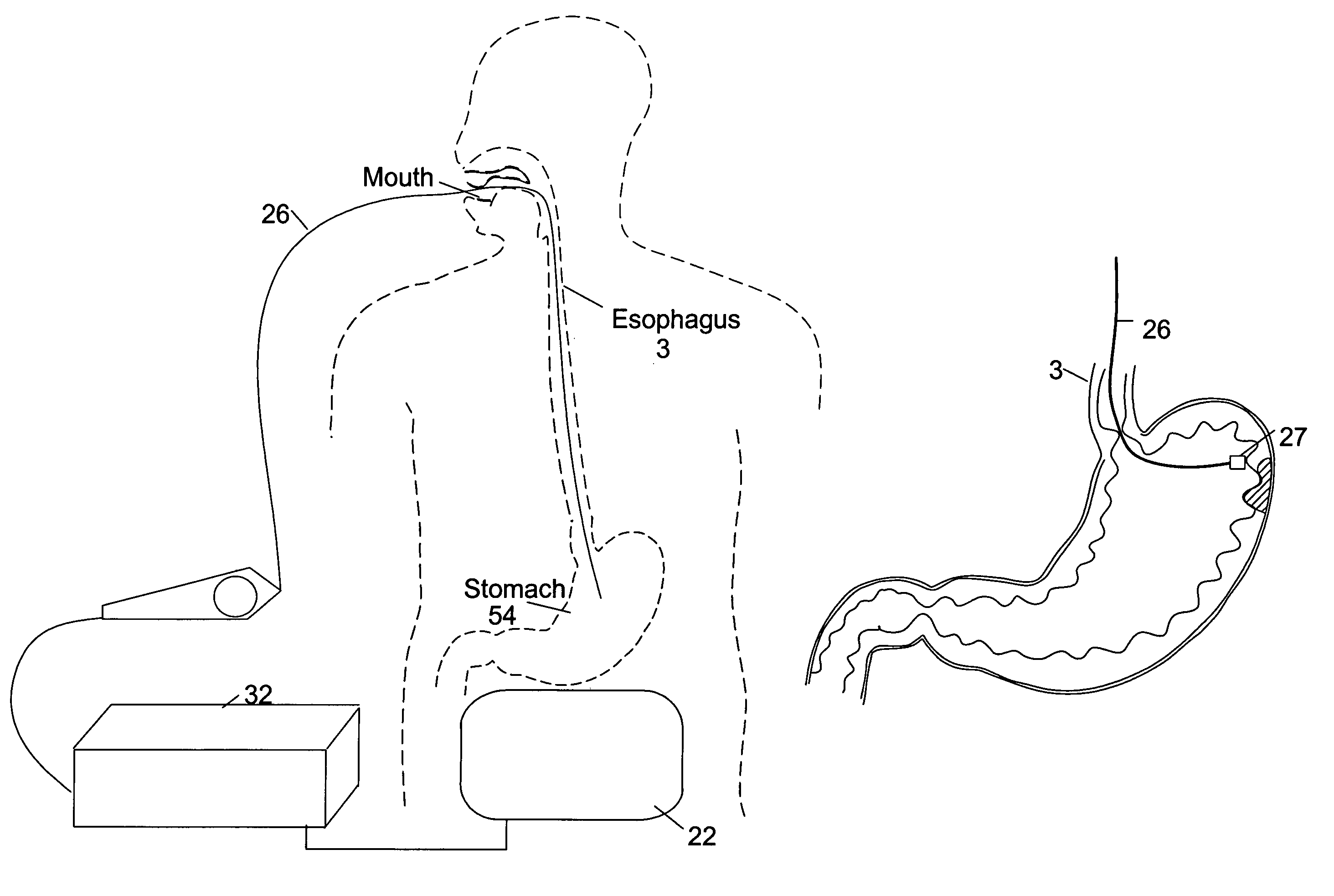 Method and system for gastric ablation and gastric pacing to provide therapy for obesity, motility disorders, or to induce weight loss