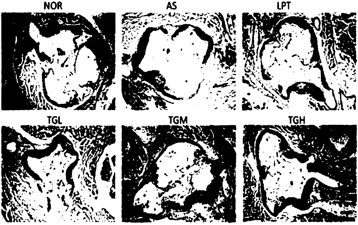 Traditional Chinese medicine composition for secondary prevention of qi deficiency and blood stasis syndrome myocardial infarction