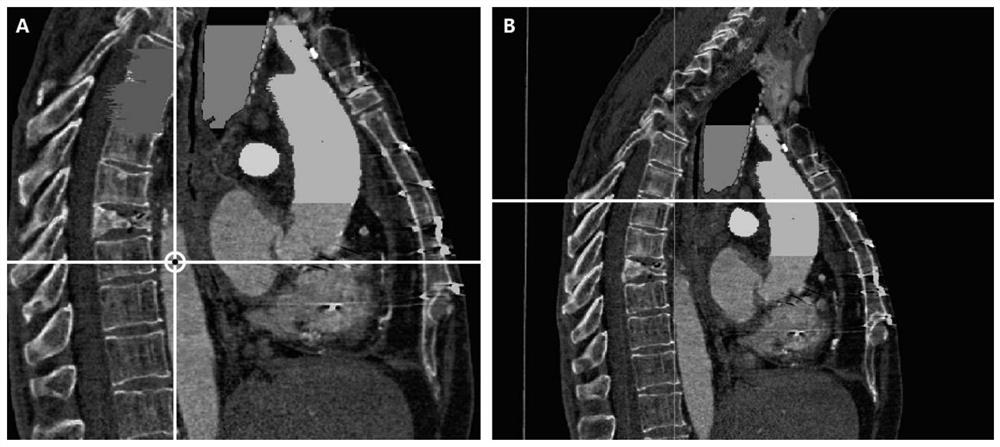 Parametric modeling method of ascending aorta, aortic arch and its three branches