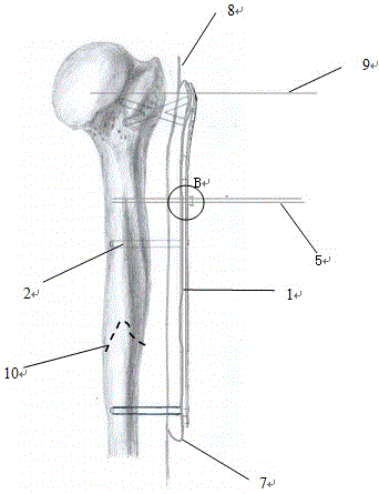 Skin-outside fixation locker for fracture