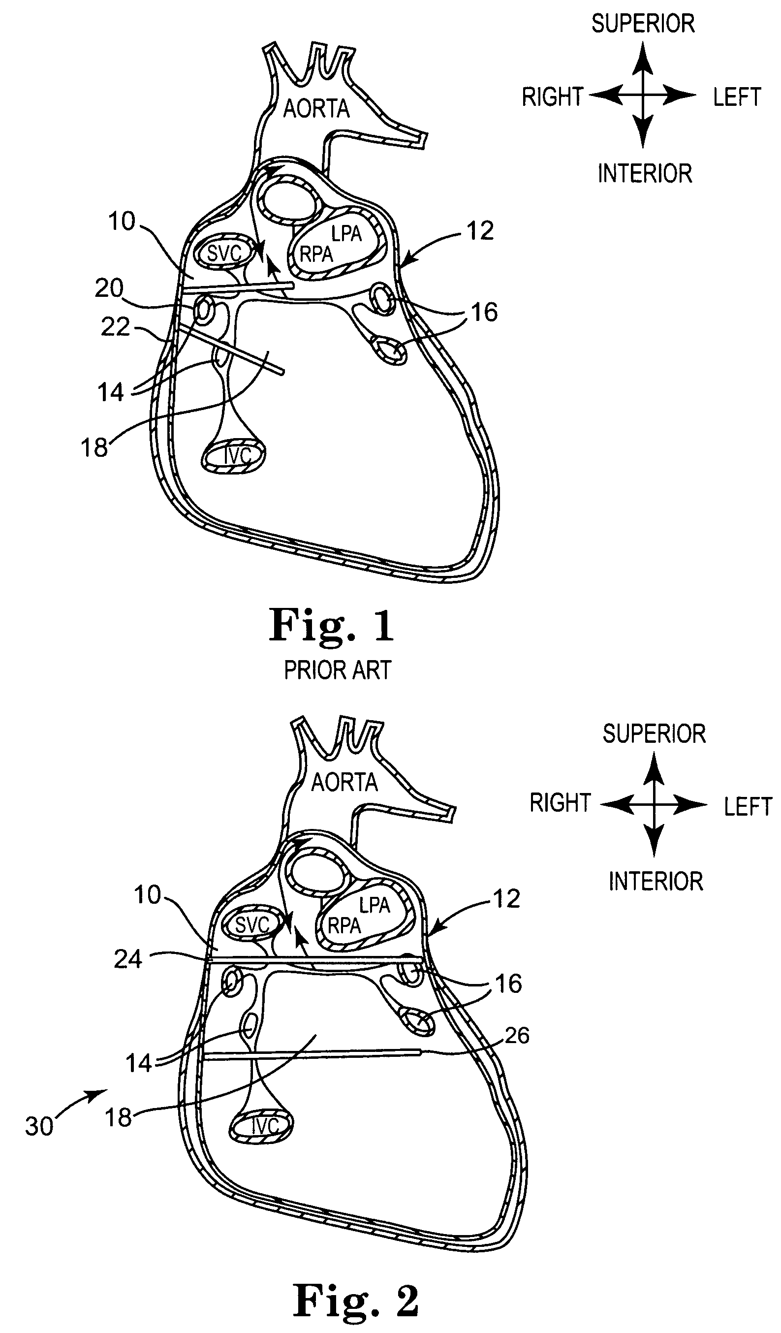 Compound bipolar ablation device and method