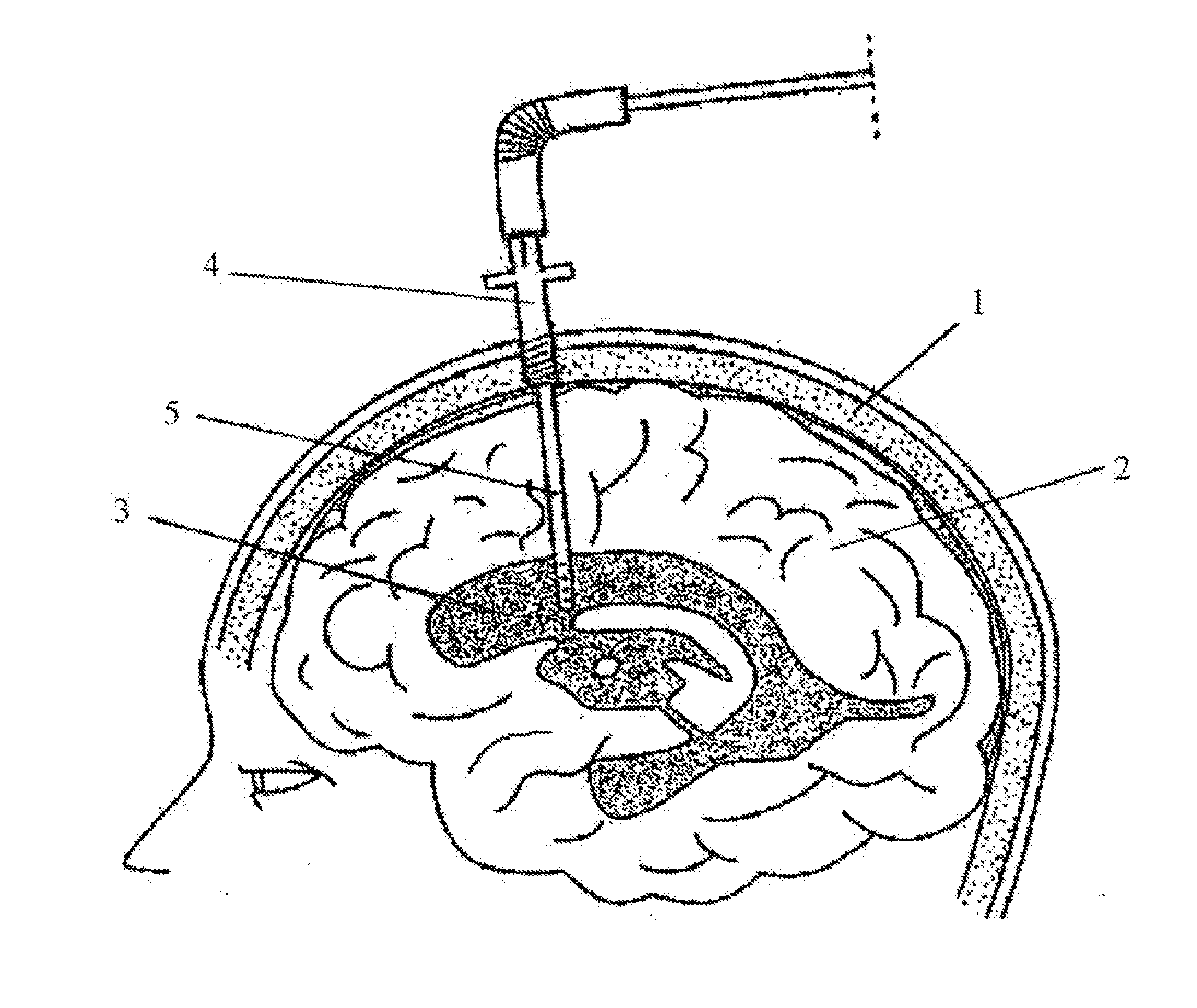 Central Nervous System Drain