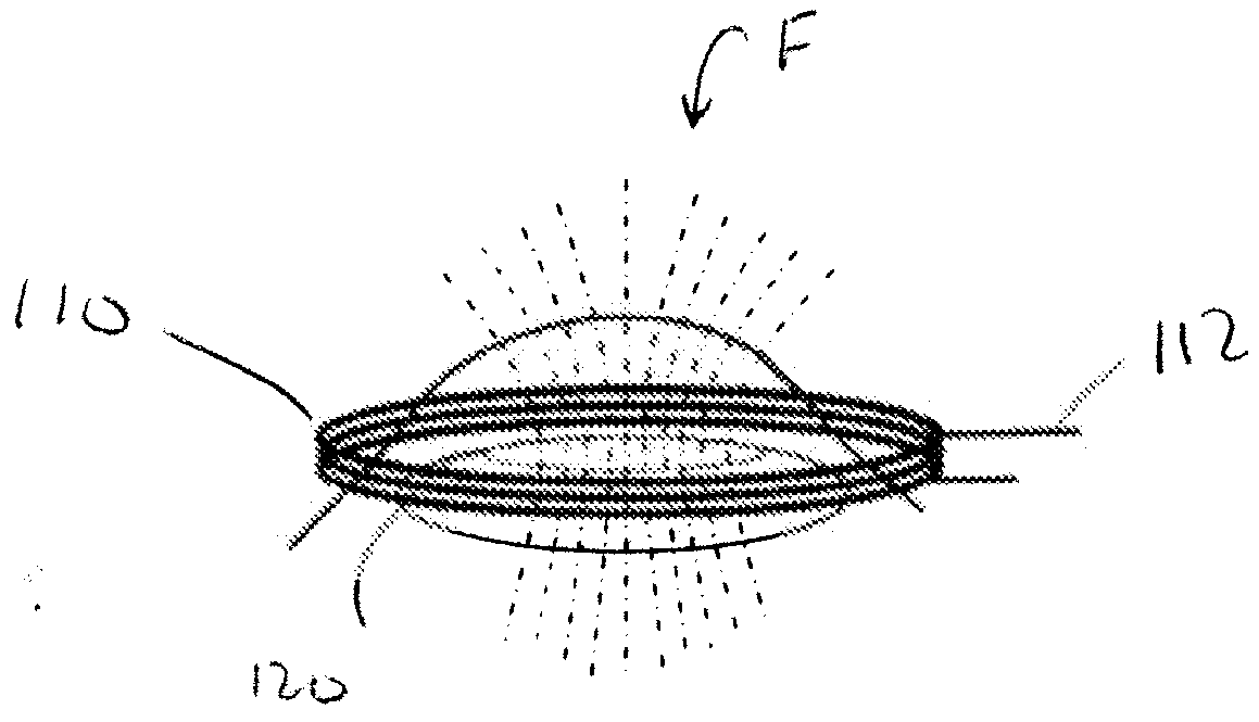 Capsulotomy device and method using electromagnetic induction heating