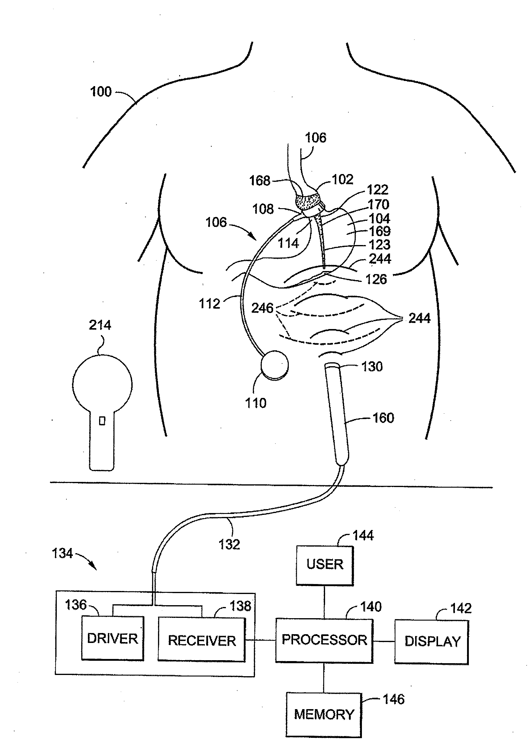 External sensing systems and methods for gastric restriction devices