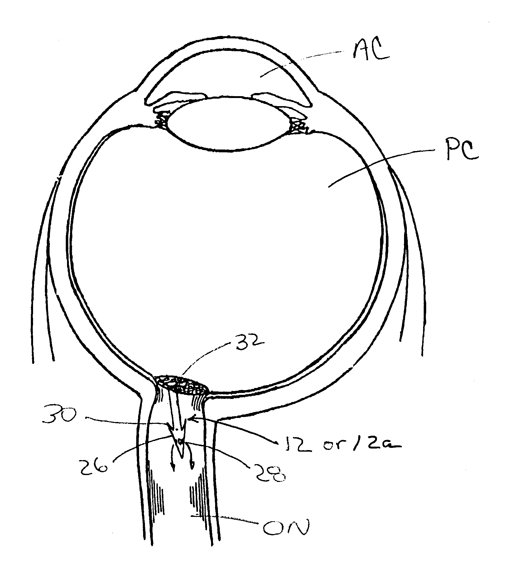 Optic nerve implants