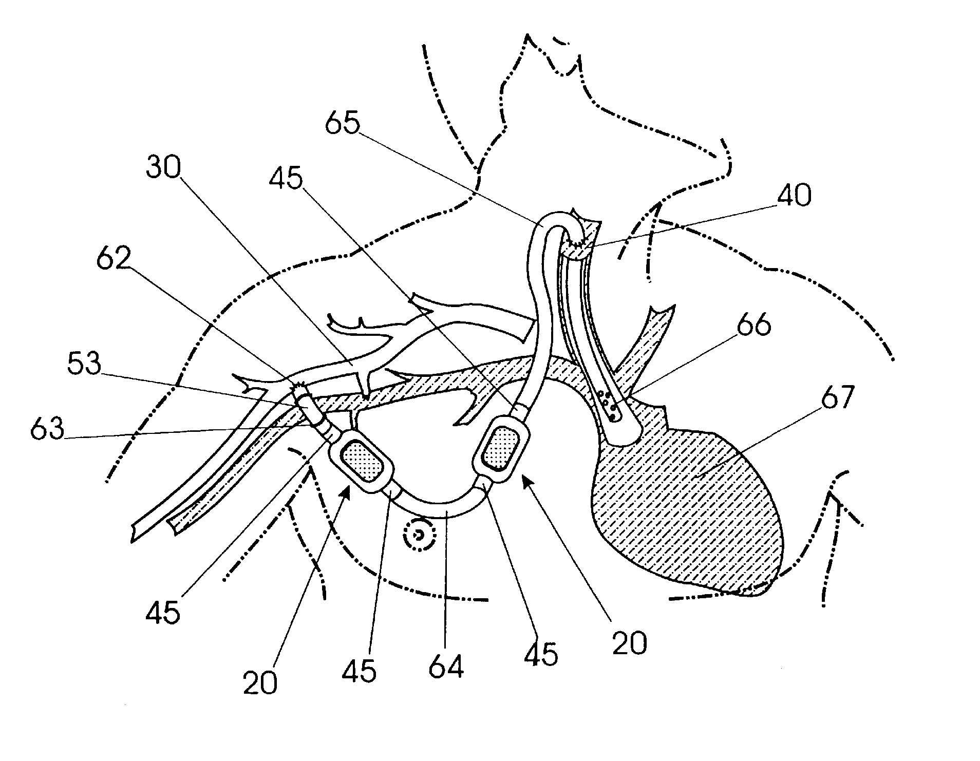 Hemodialysis and vascular access system