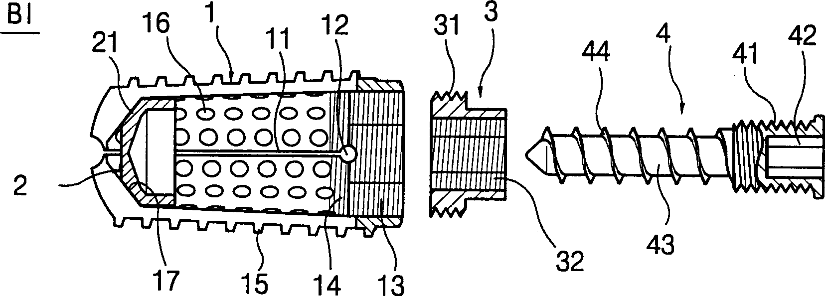 Spondylodesis graft