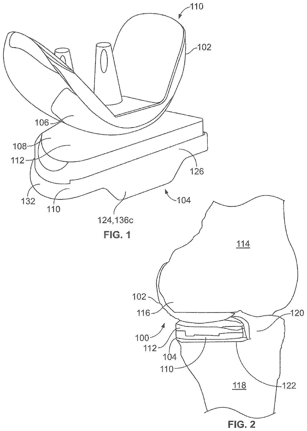 Unicondylar tibia implants