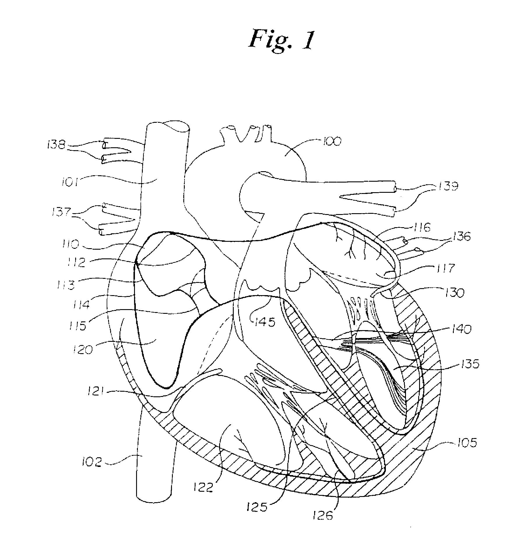 Percutaneous catheter and guidewire for filtering during ablation of myocardial or vascular tissue