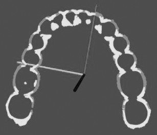 Gingival line automatic extraction method based on digital tooth model