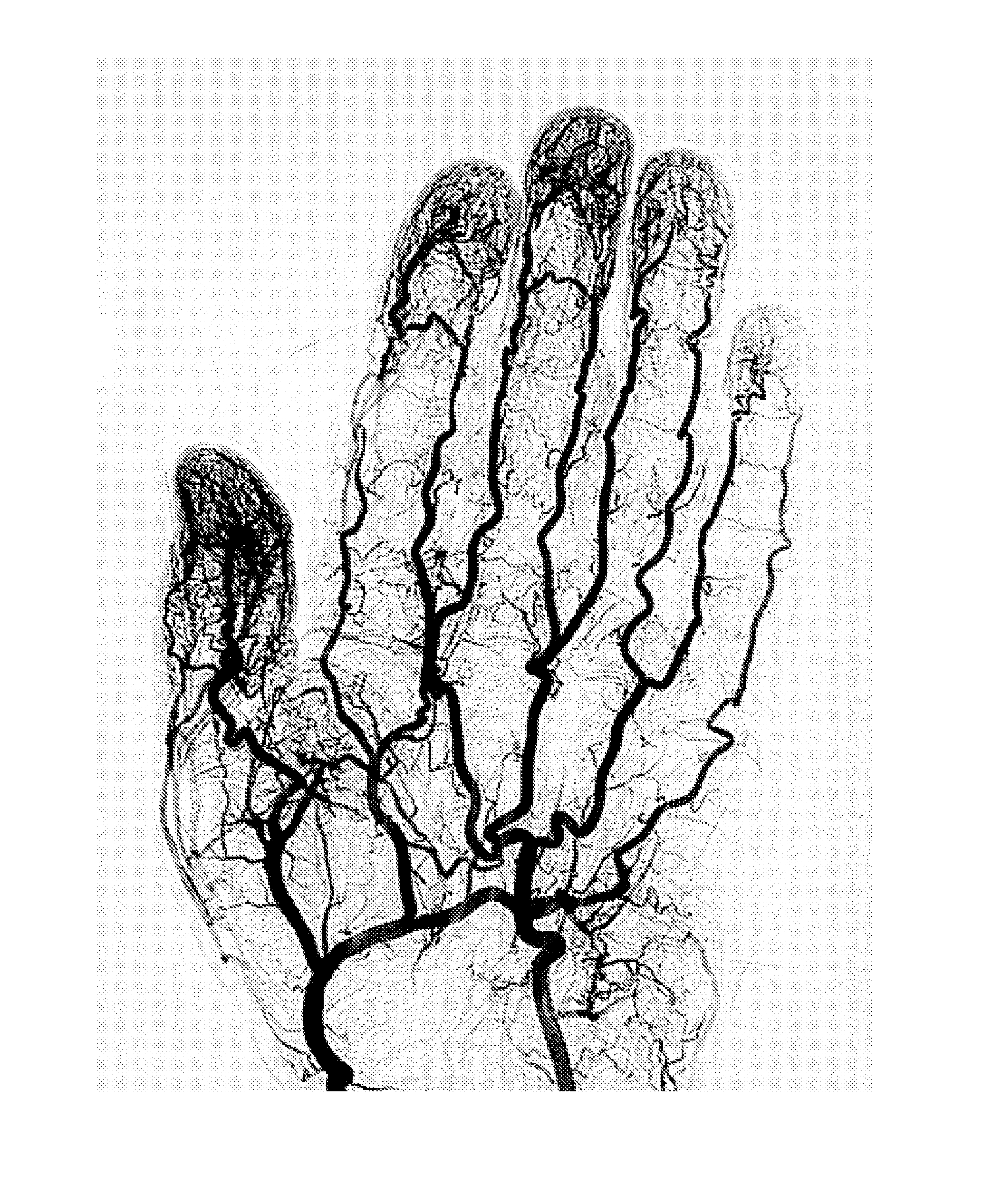 Nmr sensor and methods for rapid, non-invasive determination of hydration state or vascular volume of a subject