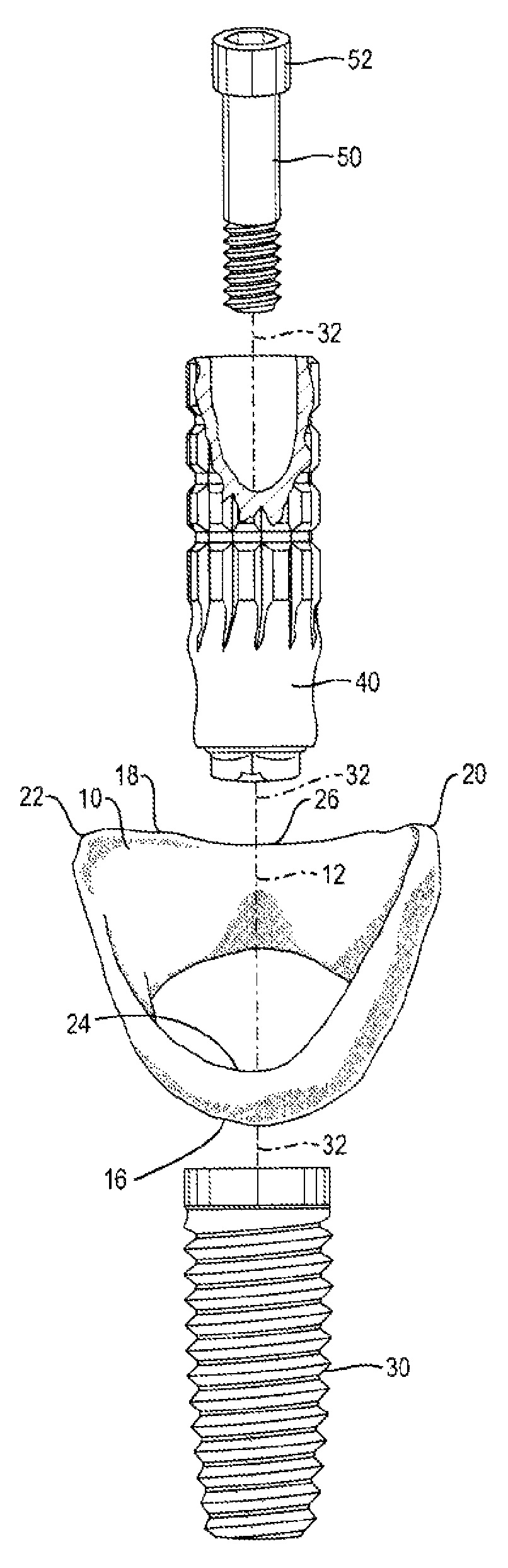 Method and apparatus for recording spatial gingival soft tissue relationship to implant placement within alveolar bone for immediate-implant placement