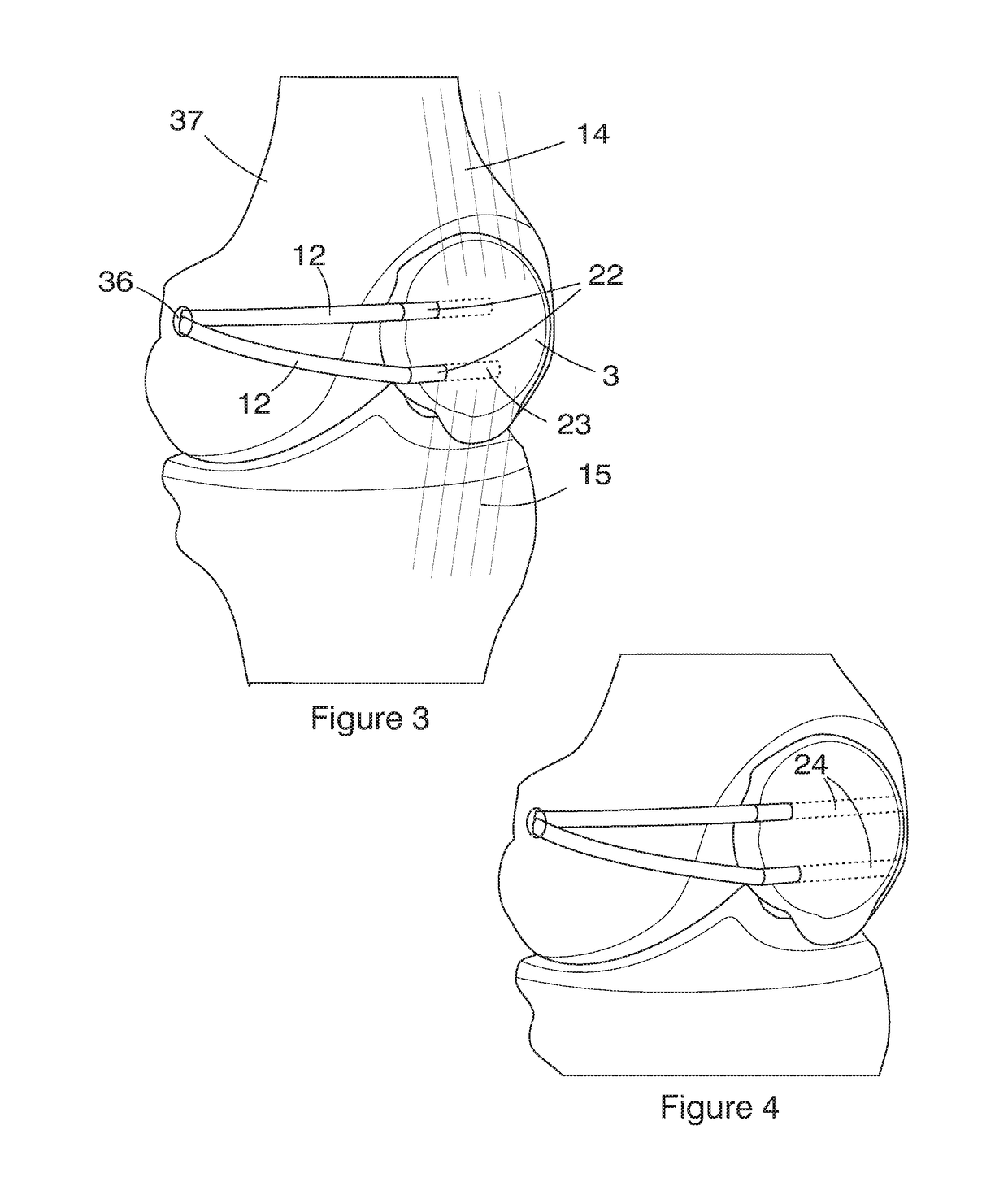 Accessory for conducting patella surgery