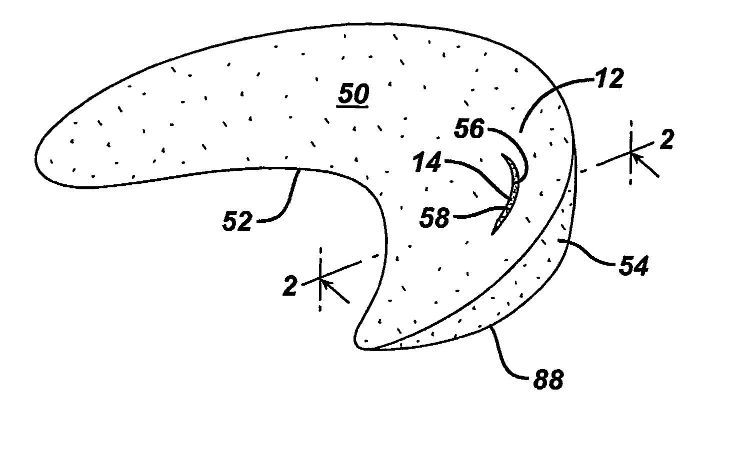 Unitary surgical device and method